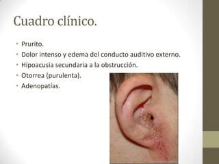 Cuadro clínico.
•
•
•
•
•

Prurito.
Dolor intenso y edema del conducto auditivo externo.
Hipoacusia secundaria a la obstrucción.
Otorrea (purulenta).
Adenopatías.

 