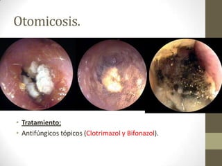 Otomicosis.

• Tratamiento:
• Antifúngicos tópicos (Clotrimazol y Bifonazol).

 