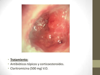 • Tratamiento:
• Antibióticos tópicos y corticoesteroides.
• Claritromicina (500 mg) V.O.

 