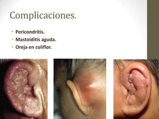 Complicaciones.
• Pericondritis.
• Mastoiditis aguda.
• Oreja en coliflor.

 