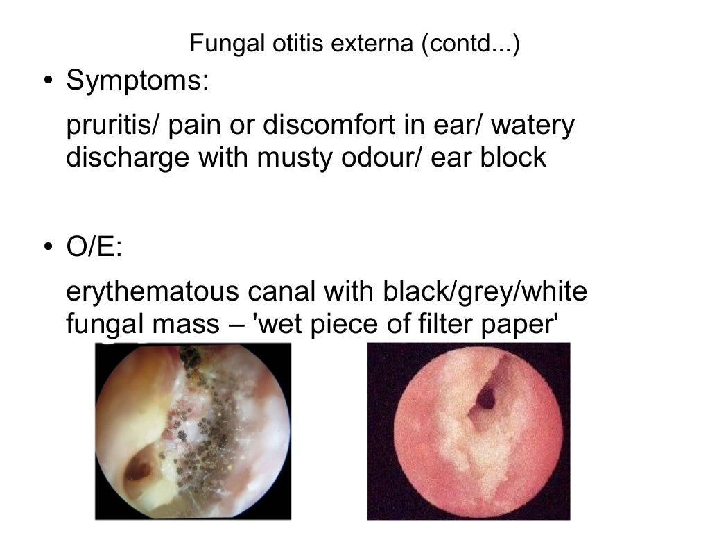Otitis externa