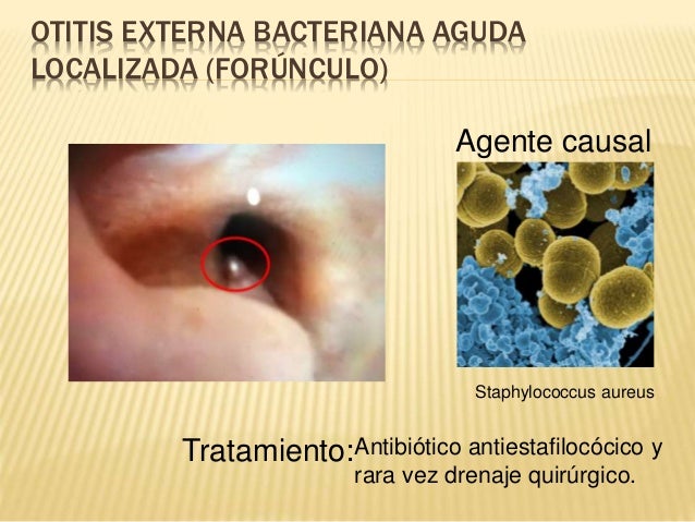 Otitis externa