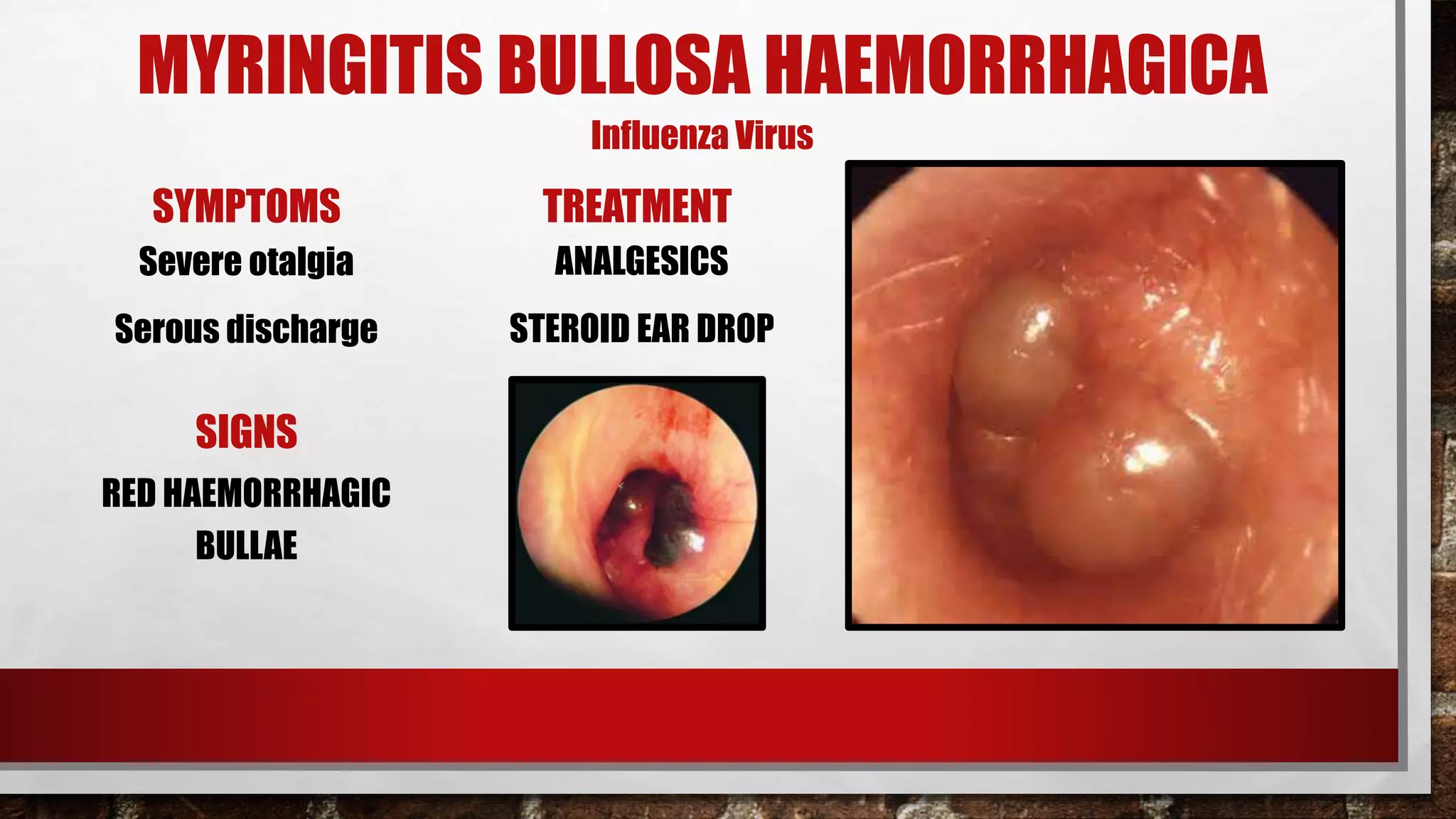 otitis-externa-pptx