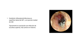 • Condición inflamatoria/infecciosa en
superficie lateral de M.T., y en porción medial
de CAE
Tipicamente en asociación con infección de
vía aérea superior, más común en invierno.
 