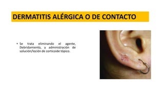 • Se trata eliminando el agente,
Debridamiento, y administración de
solución/loción de corticoide tópico.
DERMATITIS ALÉRGICA O DE CONTACTO
 