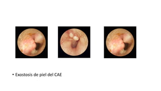 • Exostosis de piel del CAE
 