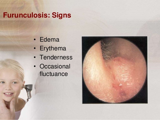 Sjogren's Syndrome Symptoms