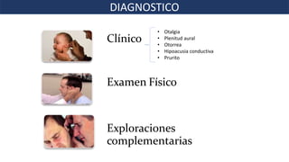 Clínico
Examen Físico
Exploraciones
complementarias
• Otalgia
• Plenitud aural
• Otorrea
• Hipoacusia conductiva
• Prurito
DIAGNOSTICO
 
