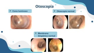 Otoscopía
 Cono luminoso  Otoscopía normal
 Membrana
timpánica normal
 