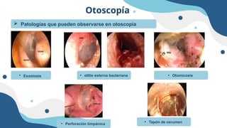Otoscopía
 Patologías que pueden observarse en otoscopía
• Exostosis • otitis externa bacteriana • Otomicosis
• Tapón de cerumen
• Perforación timpánica
 