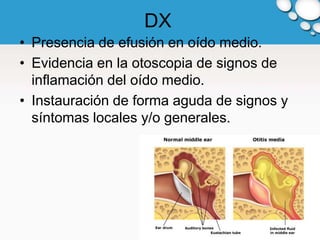 DX
• Presencia de efusión en oído medio.
• Evidencia en la otoscopia de signos de
  inflamación del oído medio.
• Instauración de forma aguda de signos y
  síntomas locales y/o generales.
 
