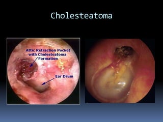 Cholesteatoma

 