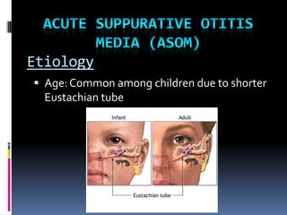 Etiology
 Age: Common among children due to shorter

Eustachian tube

 