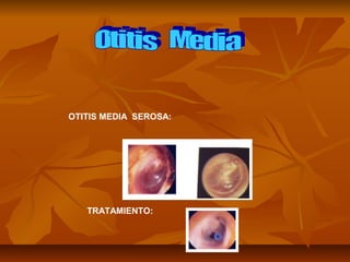 OTITIS MEDIA SEROSA:
TRATAMIENTO:
 