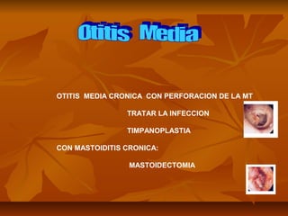 OTITIS MEDIA CRONICA CON PERFORACION DE LA MT
TRATAR LA INFECCION
TIMPANOPLASTIA
CON MASTOIDITIS CRONICA:
MASTOIDECTOMIA
 