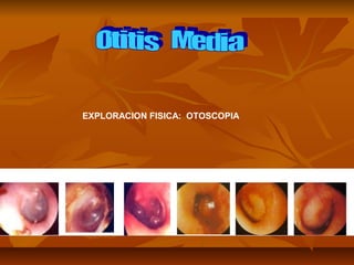 EXPLORACION FISICA: OTOSCOPIA
 