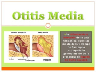La inflamación e
infección de la caja
timpánica, celdillas
mastoideas y trompa
de Eustaquio
acompañada
generalmente de la
presencia de líquido
en dicha cavidad.
 