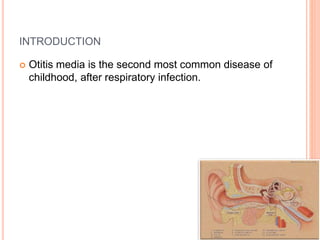 INTRODUCTION
 Otitis media is the second most common disease of
childhood, after respiratory infection.
 
