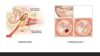 TYMPANOTOMY TYMPANOPLASTY
 