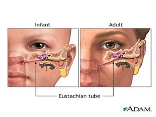 Otitis Media.ppt-occurs in the area between the tympanic membrane (the ...