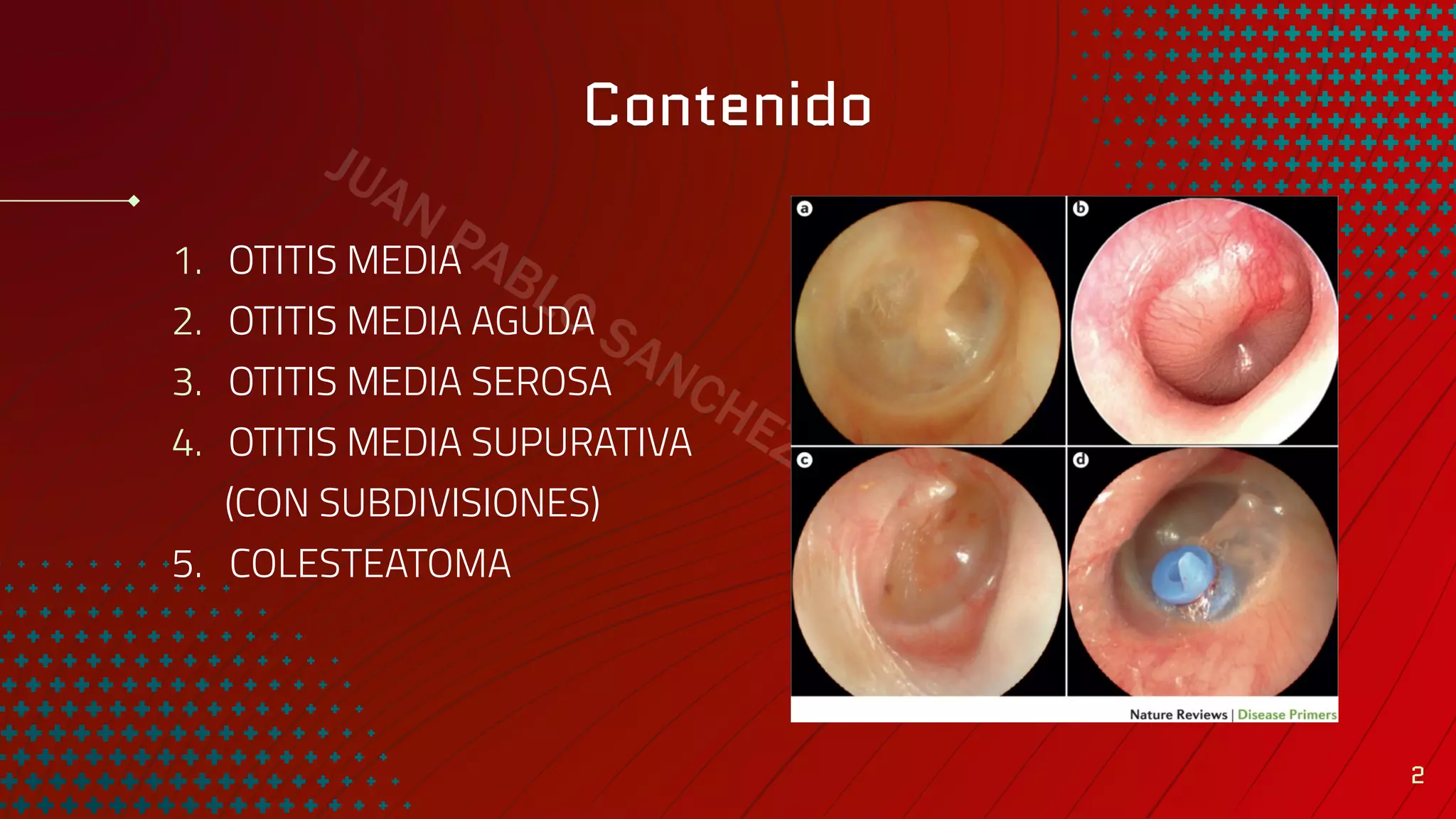 otitis-media-aguda-y-cronica-pdf