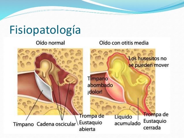 Resultado de imagen para otitis media