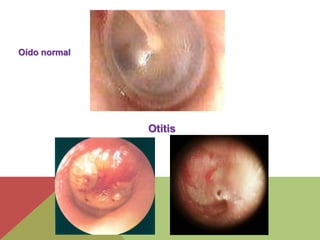 Oído normal 
Otitis 
 