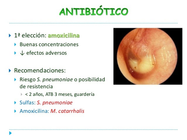 Otitis media aguda