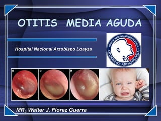 OTITIS MEDIA AGUDA
Hospital Nacional Arzobispo Loayza
MR3 Walter J. Florez Guerra
 