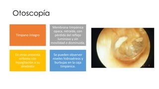 Otitis Media Aguda pptx otitis-media-aguda-pptx