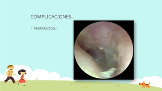 COMPLICACIONES.-
 PERFORACIÓN.-
 