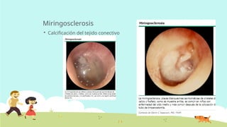 Miringosclerosis
 Calcificación del tejido conectivo
 