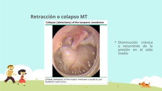 Retracción o colapso MT
 Disminución crónica
o recurrente de la
presión en el oído
medio
 
