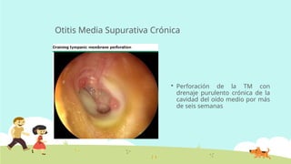 Otitis Media Supurativa Crónica
 Perforación de la TM con
drenaje purulento crónica de la
cavidad del oído medio por más
de seis semanas
 