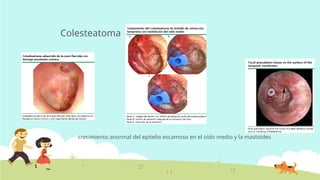 Colesteatoma
crecimiento anormal del epitelio escamoso en el oído medio y la mastoides
 