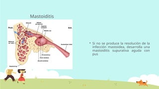 Mastoiditis
 Si no se produce la resolución de la
infección mastoidea, desarrolla una
mastoiditis supurativa aguda con
pus
 