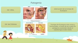 Patogenia
INF. VIRAL
obstrucción de la trompa de
Eustaquio
INF. BACTERIANA Trompas de Eustaquio más cortas y
horizontales, a través de las cuales los
patógenos ascienden desde el
nasofaringe al oído medio
 