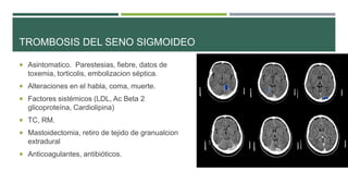 TROMBOSIS DEL SENO SIGMOIDEO
 Asintomatico. Parestesias, fiebre, datos de

toxemia, torticolis, embolizacion séptica.
 Alteraciones en el habla, coma, muerte.
 Factores sistémicos (LDL, Ac Beta 2

glicoproteína, Cardiolipina)
 TC, RM.
 Mastoidectomia, retiro de tejido de granualcion

extradural
 Anticoagulantes, antibióticos.

 