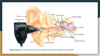 Timpanometría: Actualmente es el GOLD standard como prueba diagnóstica para OMA
 