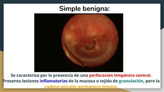 Simple benigna:
Se caracteriza por la presencia de una perforación timpánica central.
Presenta lesiones inflamatorias de la mucosa o tejido de granulación, pero la
cadena osicular permanece íntegra.
 