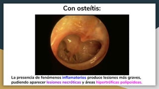 Con osteítis:
La presencia de fenómenos inflamatorios produce lesiones más graves,
pudiendo aparecer lesiones necróticas y áreas hipertróficas polipoideas.
 