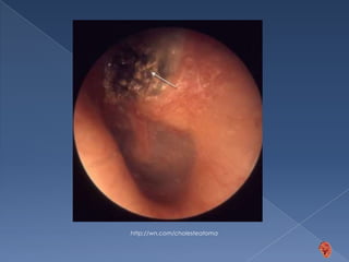 b. Epitímpano2ª ubicación más frecuenteObstrucción de la cadena osicularÁrea anterior de la cabeza del martilloAdecuada exposiciónhttp://www.encolombia.com/otorrino_vol27-2-99otitis2.htmLalwani A.K. Diagnóstico y tratamiento en Otorrinolaringología, Cirugía de cabeza y cuello. 2ª edición. McGraw-Hill Interamericana. México, 2009. pp. 666 – 672
