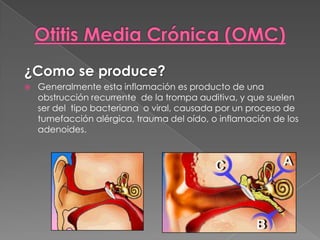 ¿Como se produce?
   Generalmente esta inflamación es producto de una
    obstrucción recurrente de la trompa auditiva, y que suelen
    ser del tipo bacteriana o viral, causada por un proceso de
    tumefacción alérgica, trauma del oído, o inflamación de los
    adenoides.
 