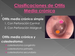 :
 Otitis media crónica simple
                                    2
  1. Con Perforación Central
  2. Con Perforación Marginal
                                1

Otitis media crónica y
colesteatoma:
   colesteatoma congénito
   colesteatoma primario
   colesteatoma secundario
 