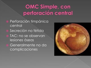  Perforación timpánica
  central
 Secreción no fétida
 TAC: no se observan
  lesiones óseas
 Generalmente no da
  complicaciones
 