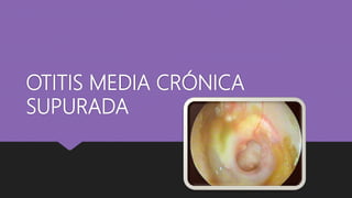 OTITIS MEDIA CRÓNICA
SUPURADA
 