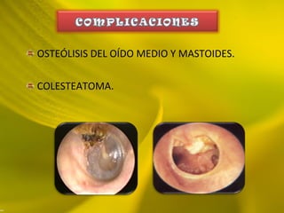 OSTEÓLISIS DEL OÍDO MEDIO Y MASTOIDES.
COLESTEATOMA.
 
