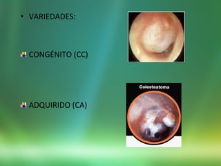 • VARIEDADES:
CONGÉNITO (CC)
ADQUIRIDO (CA)
 