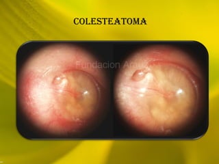 COLESTEATOMA
 