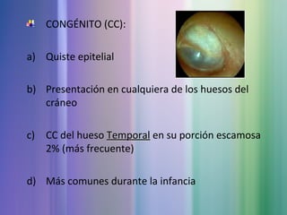 CONGÉNITO (CC):
a) Quiste epitelial
b) Presentación en cualquiera de los huesos del
cráneo
c) CC del hueso TemporalTemporal en su porción escamosa
2% (más frecuente)
d) Más comunes durante la infancia
 